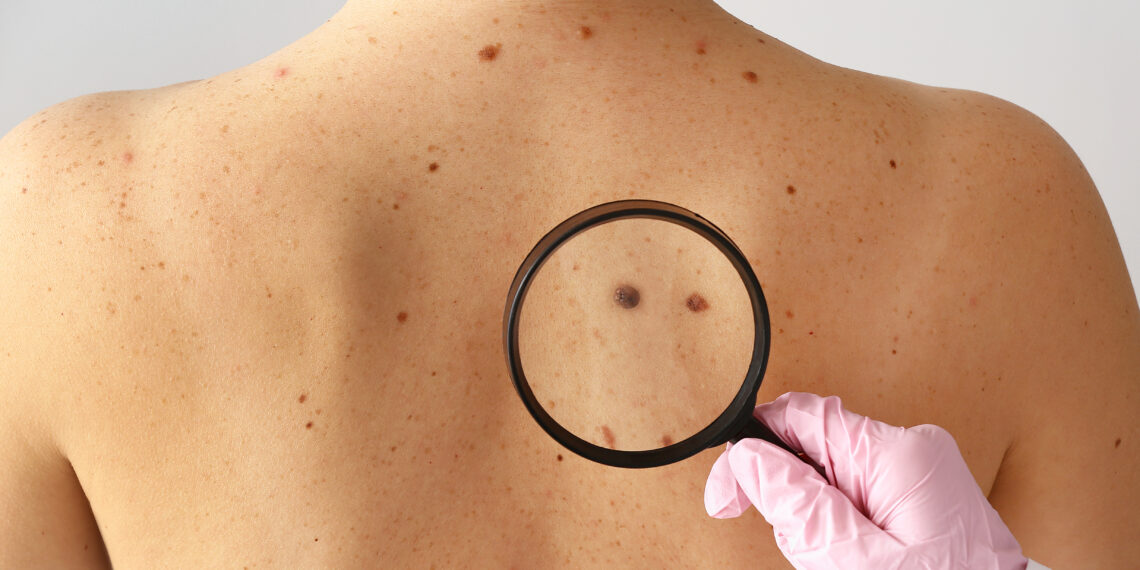 Dermatologist examining moles of patient in clinic